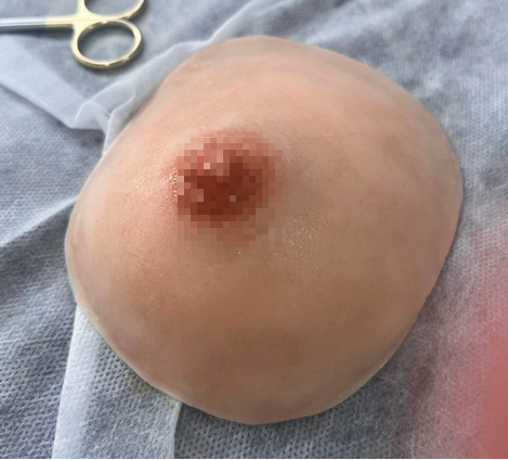 Breast Prosthesis